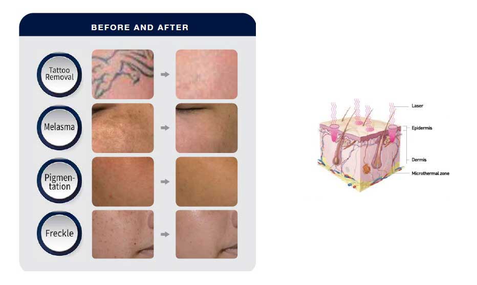 IDS - Tatto Removal Laser Model Pico Premium